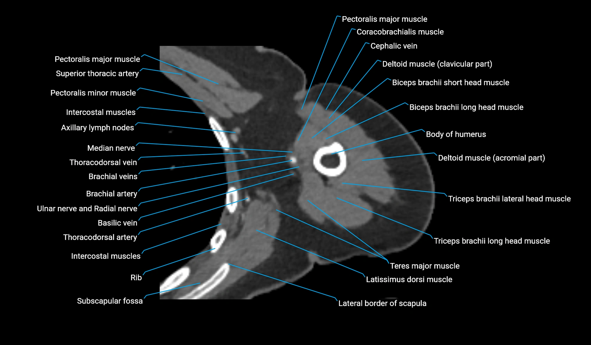 CT upper arm axial  cross sectional anatomy labelled radiology image -00162.webp